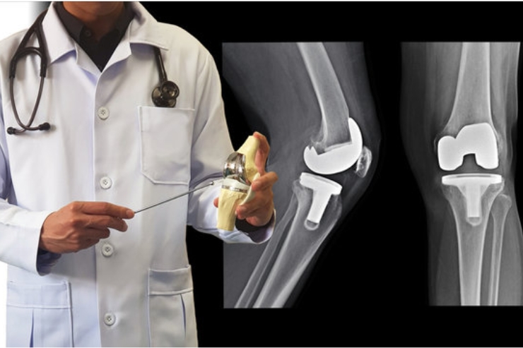 Joint Replacement Surgeries------23